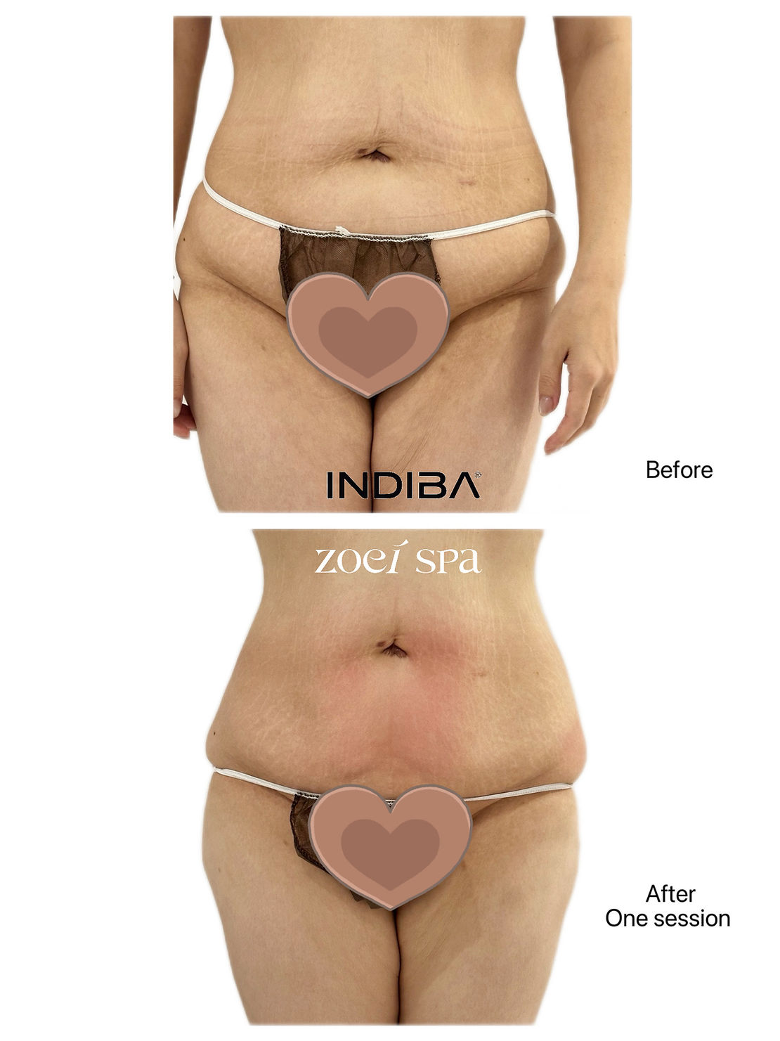 INDIBA 英特波 — 腰圍 -6.5cm 一個療程的改變