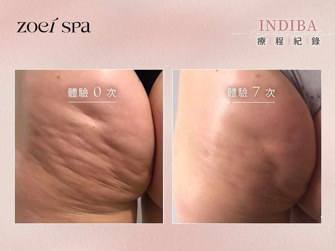 INDIBA 英特波 — 臀腿線條緊實平滑回彈